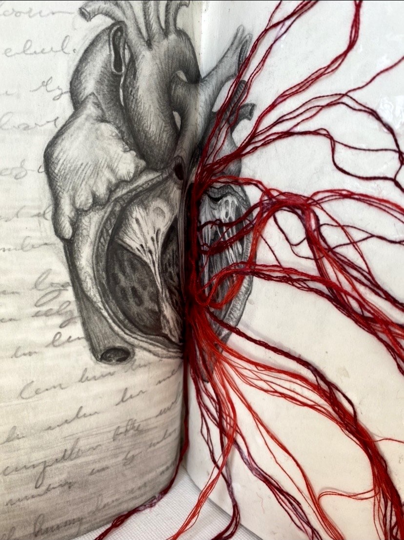 Broken Heart Syndrome Unravelled Out Of Our Heads Art In Medicine Online